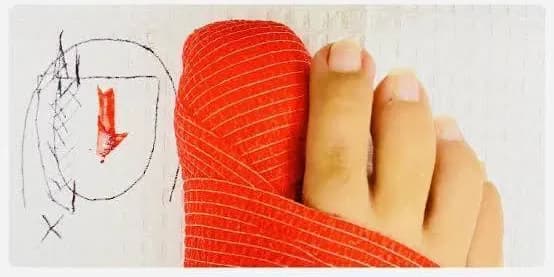 A big toe with the edge of the nail marked, resting on a red cloth